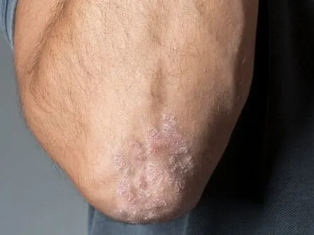 Psoriasis Fredericksburg TX