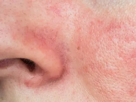 Rosacea Fredericksburg TX