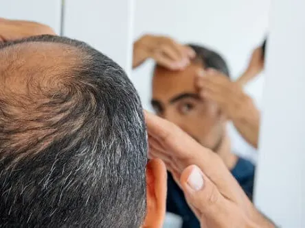 Hair Loss Fredericksburg TX