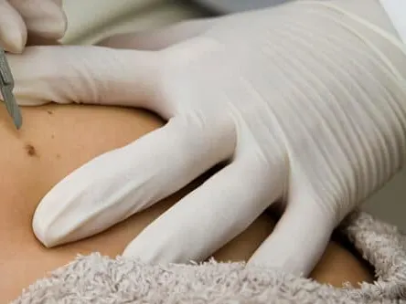 Regular Skin Cancer Excision Fredericksburg TX