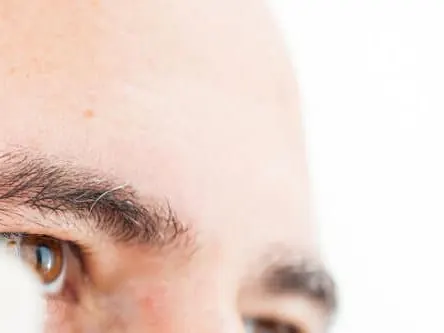 Removing Age/Wisdom Spots Fredericksburg TX