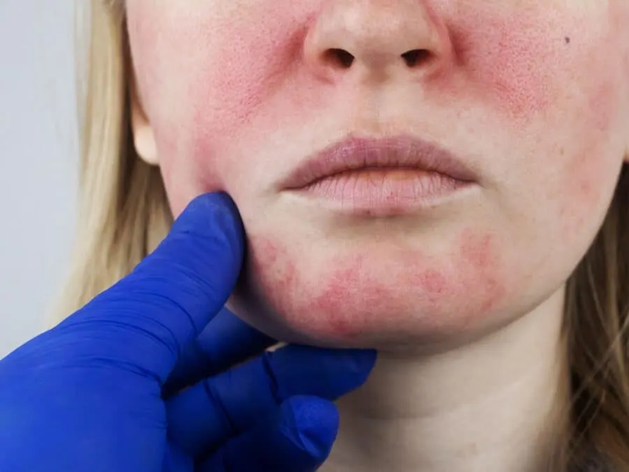Provider examining a patient's face with bright red rosacea spots that are flared up from the sun.