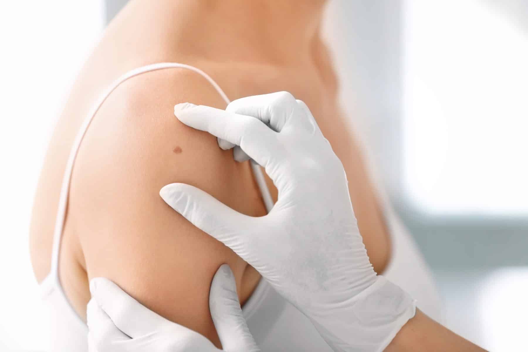 A gloved clinician examining a mole on a woman's shoulder (model)
