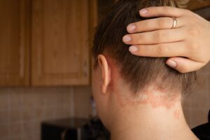 Close up of a woman pulling up her hair to show the psoriasis flar-up on the back of her neck.
