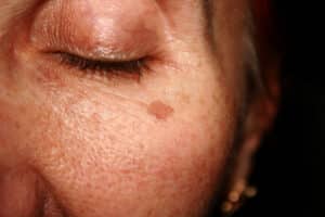 Close up of an older woman with a sun spot on her cheekbone, in need of treatment.