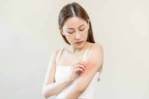 Young woman scratching at an eczema flare-up on her arm, in need of dermatology treatment