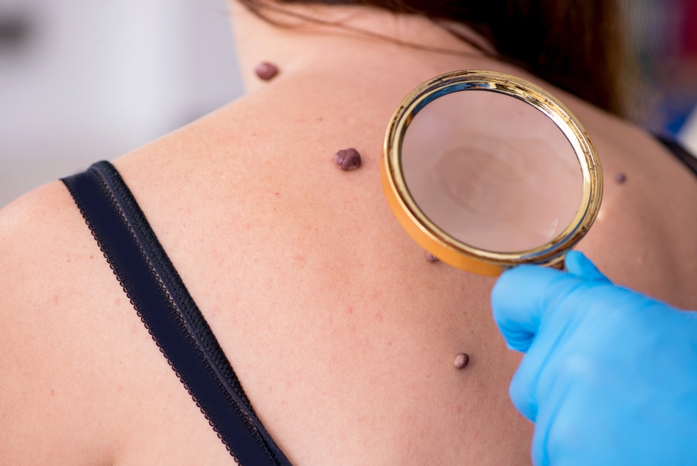 Close up of a patient having her large, dark, and textured moles examined by a dermatologist for possible melanoma.