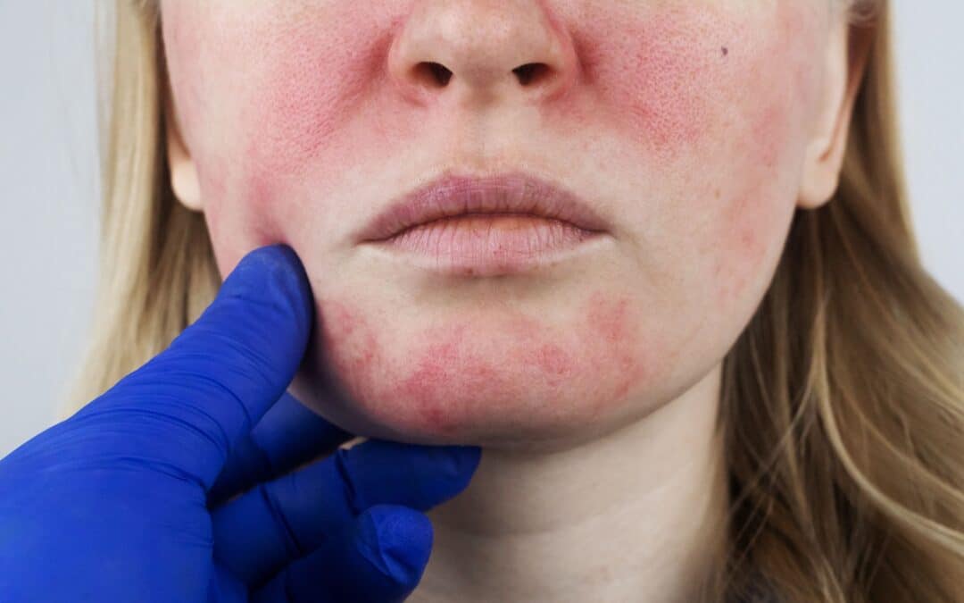 Provider examining a patient's face with bright red rosacea spots that are flared up from the sun.