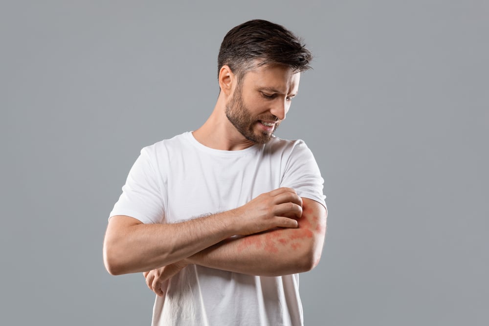 Man scratching an itchy rash on his arm due to eczema.